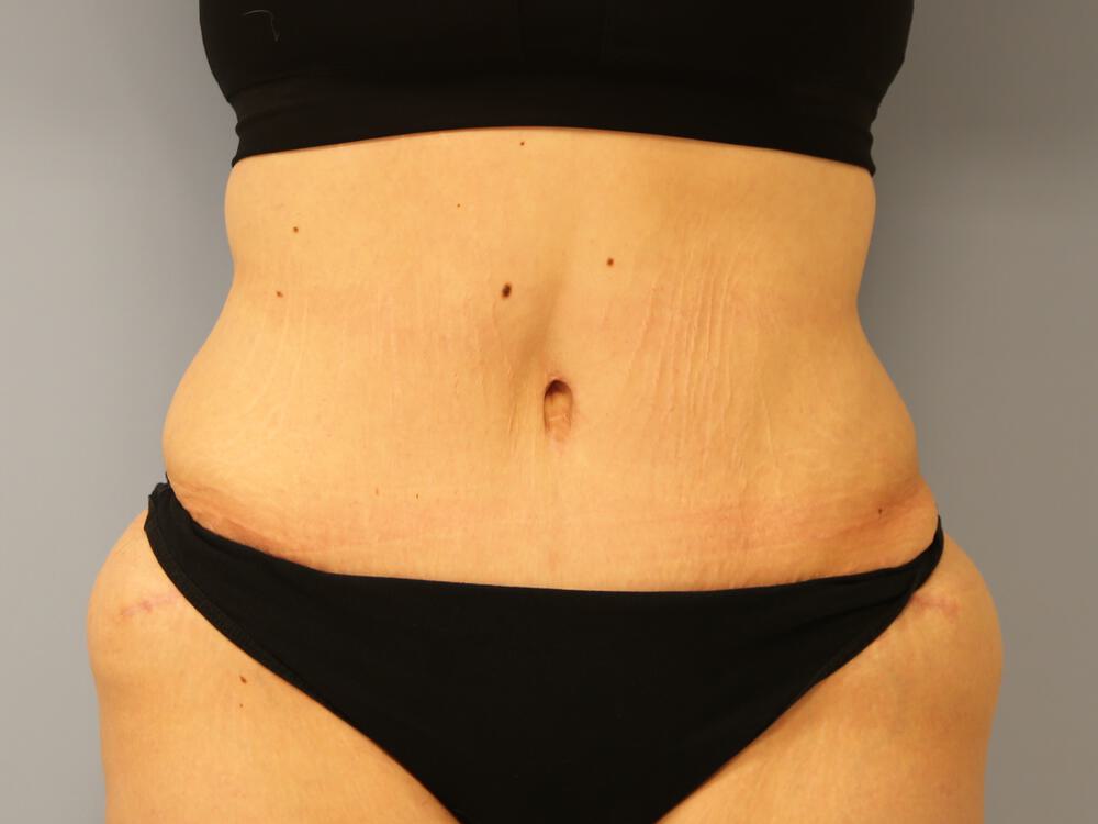 Surgery after weight loss Before & After Image