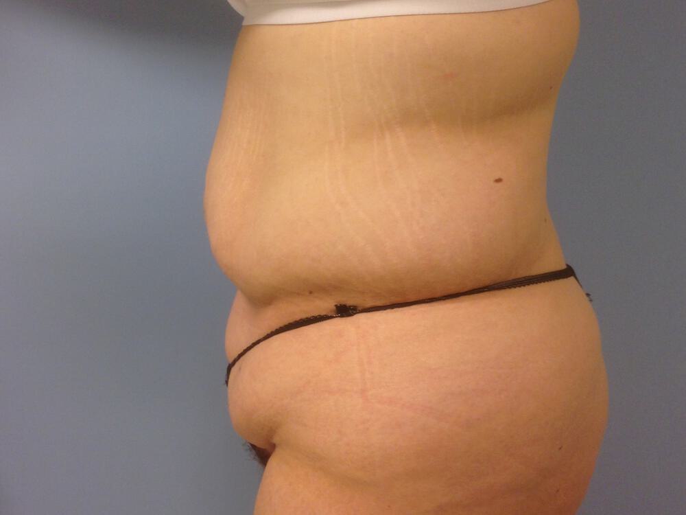 Surgery after weight loss Before & After Image