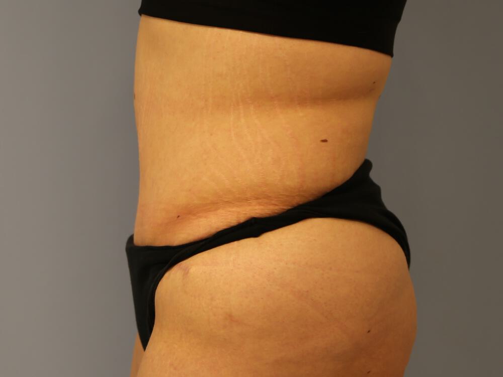 Surgery after weight loss Before & After Image