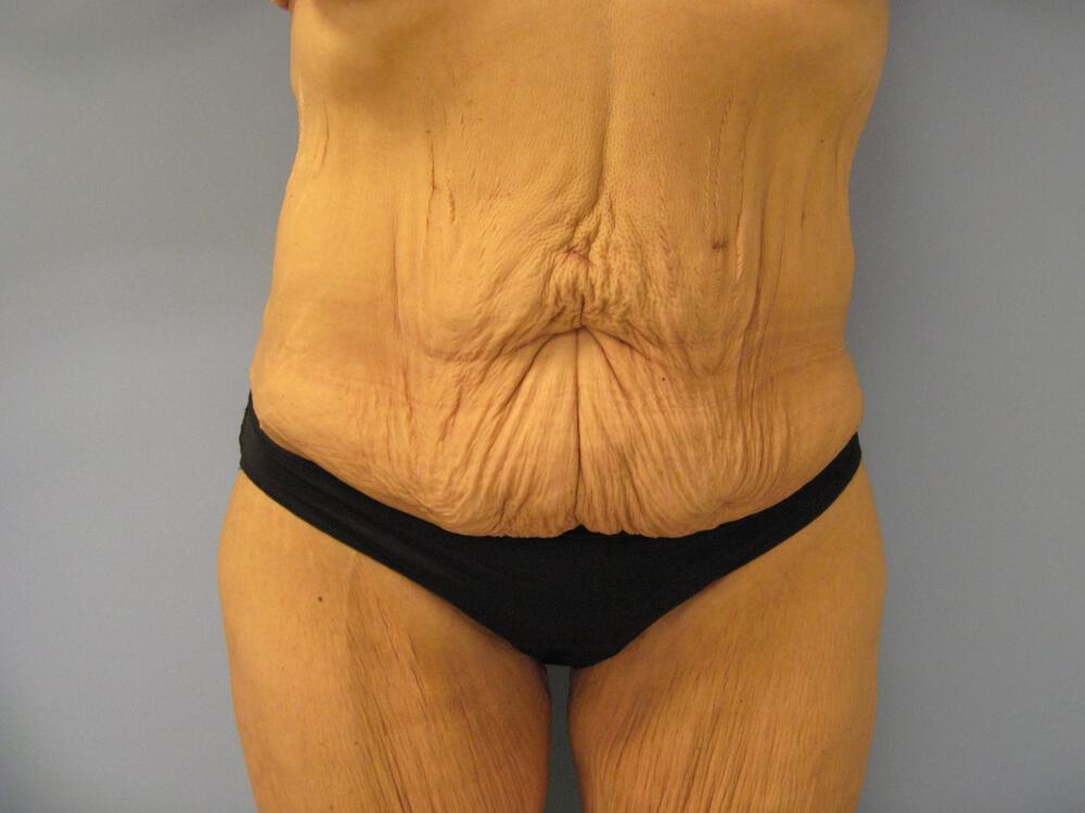 Surgery after weight loss Before & After Image