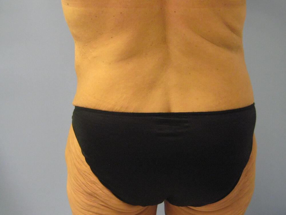 Surgery after weight loss Before & After Image