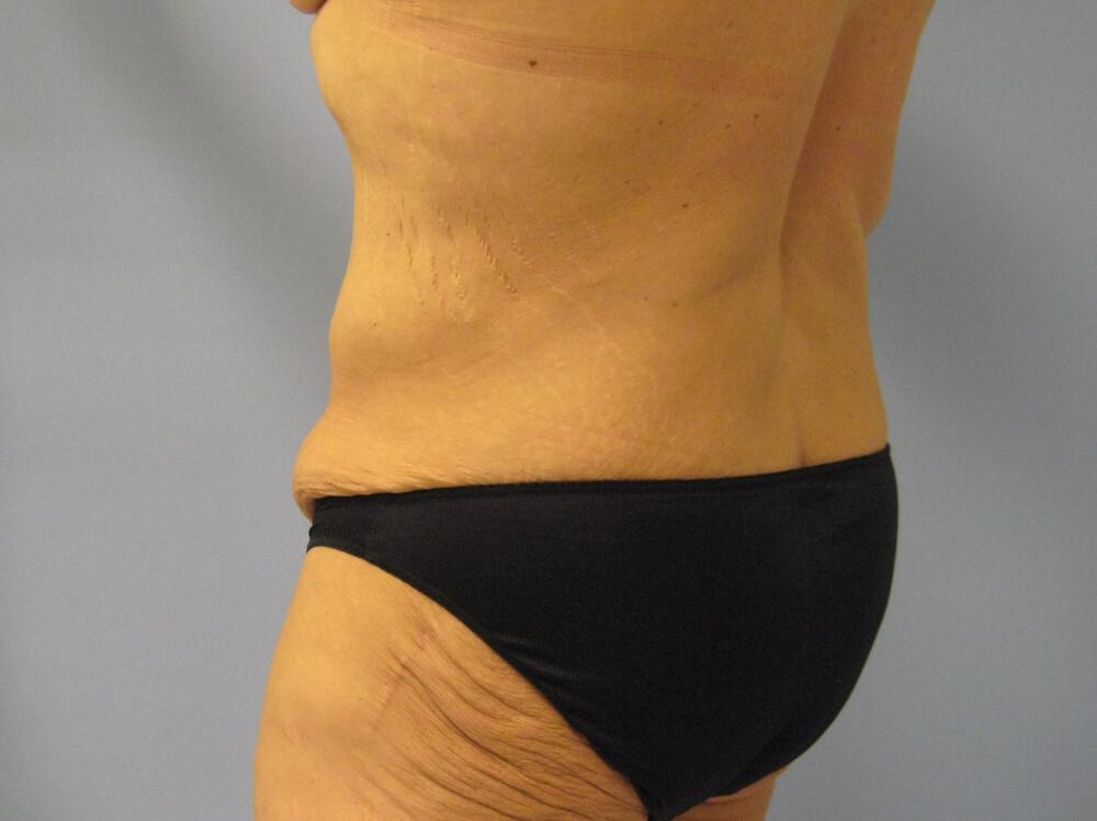 Surgery After Weight Loss Before & After Image