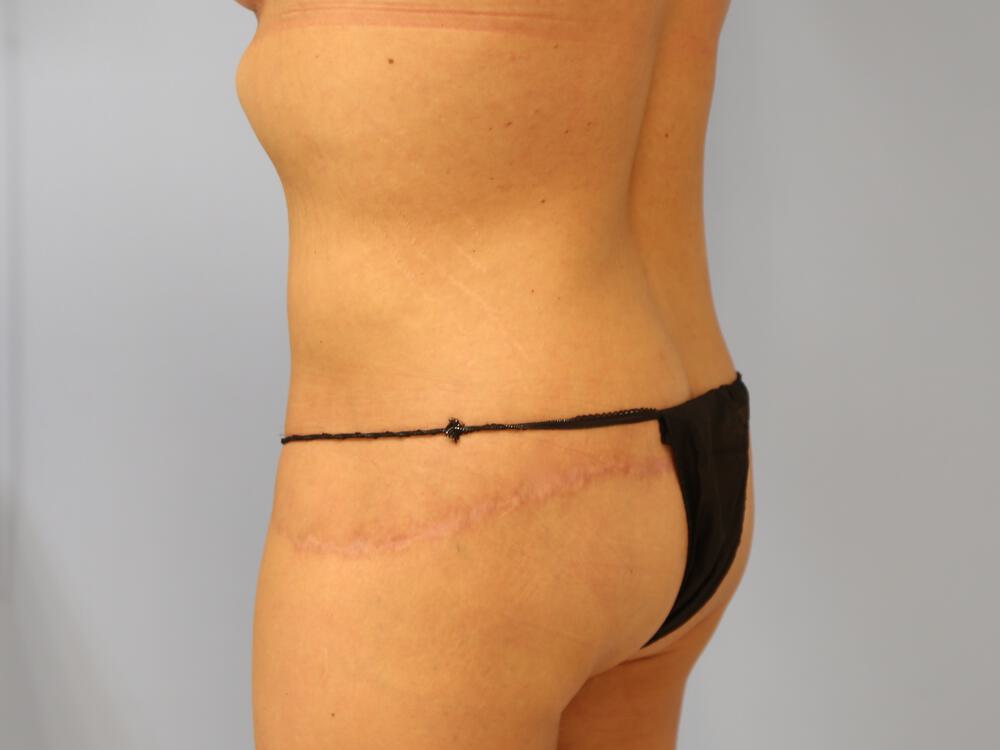 Surgery After Weight Loss Before & After Image