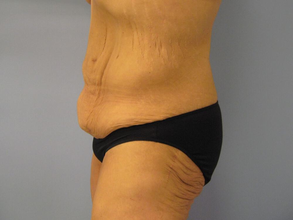 Surgery After Weight Loss Before & After Image