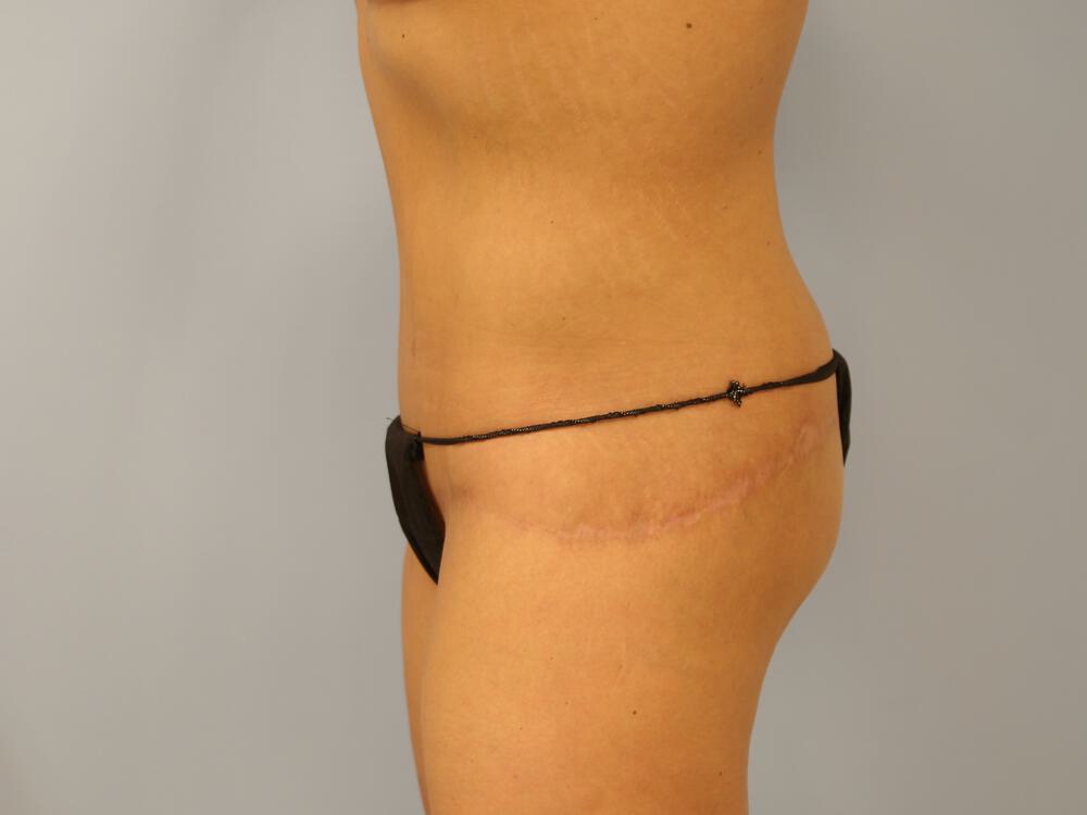 Surgery After Weight Loss Before & After Image