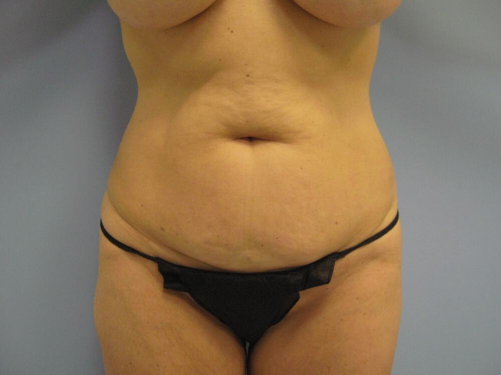 Surgery after weight loss Before & After Image