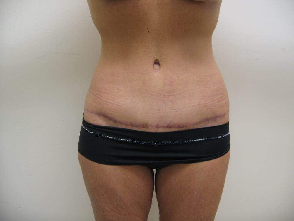 Surgery after weight loss Before & After Image