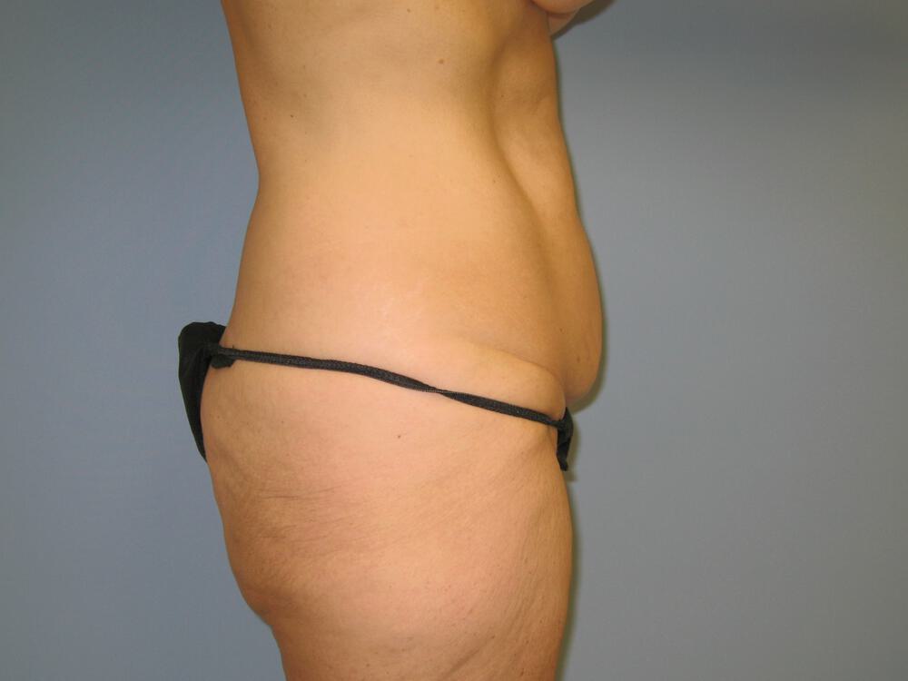 Surgery after weight loss Before & After Image