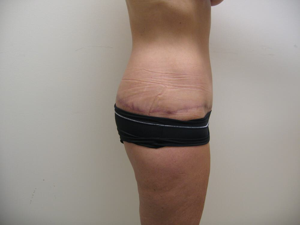 Surgery after weight loss Before & After Image