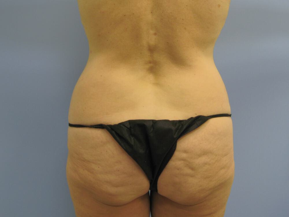 Surgery After Weight Loss Before & After Image