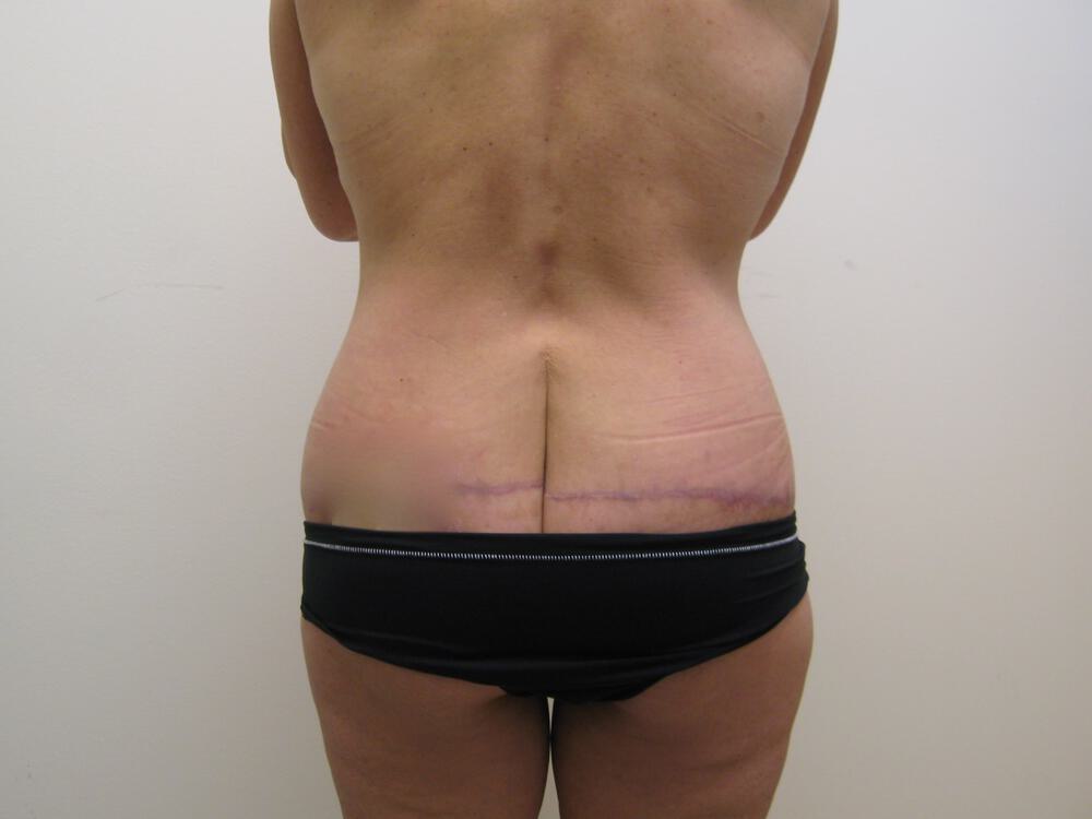 Surgery After Weight Loss Before & After Image