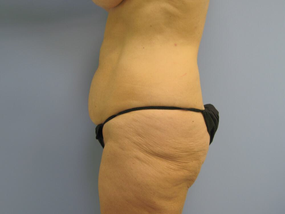 Surgery After Weight Loss Before & After Image