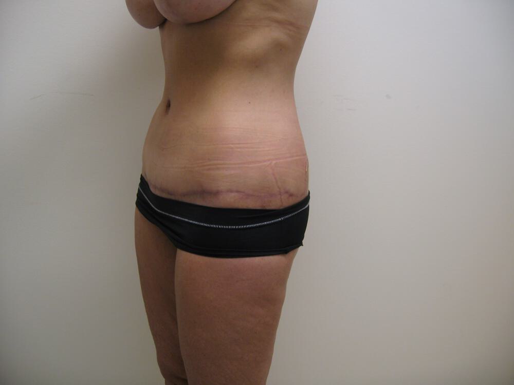 Surgery After Weight Loss Before & After Image