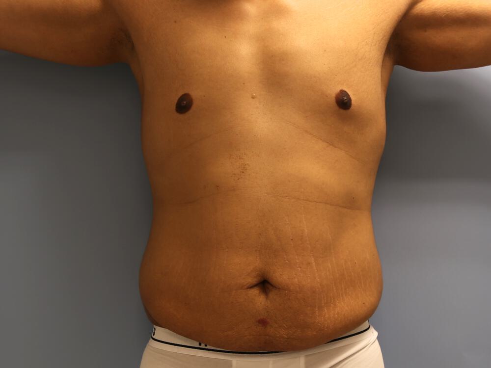 Surgery after weight loss Before & After Image