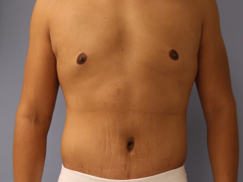 Surgery after weight loss Before & After Image