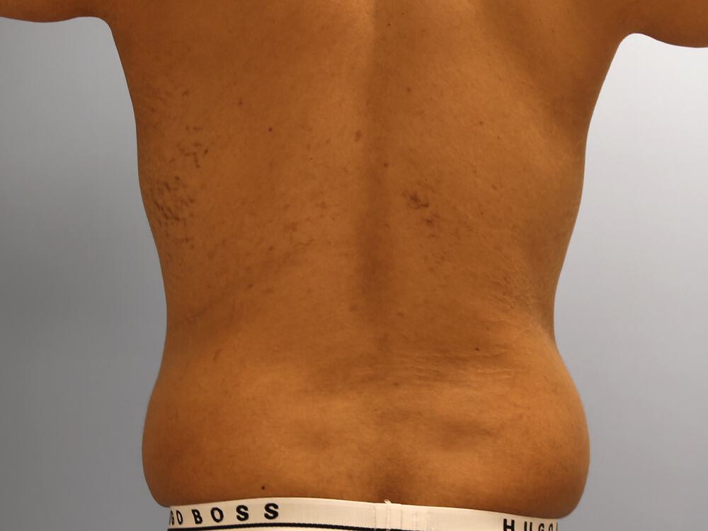 Surgery after weight loss Before & After Image