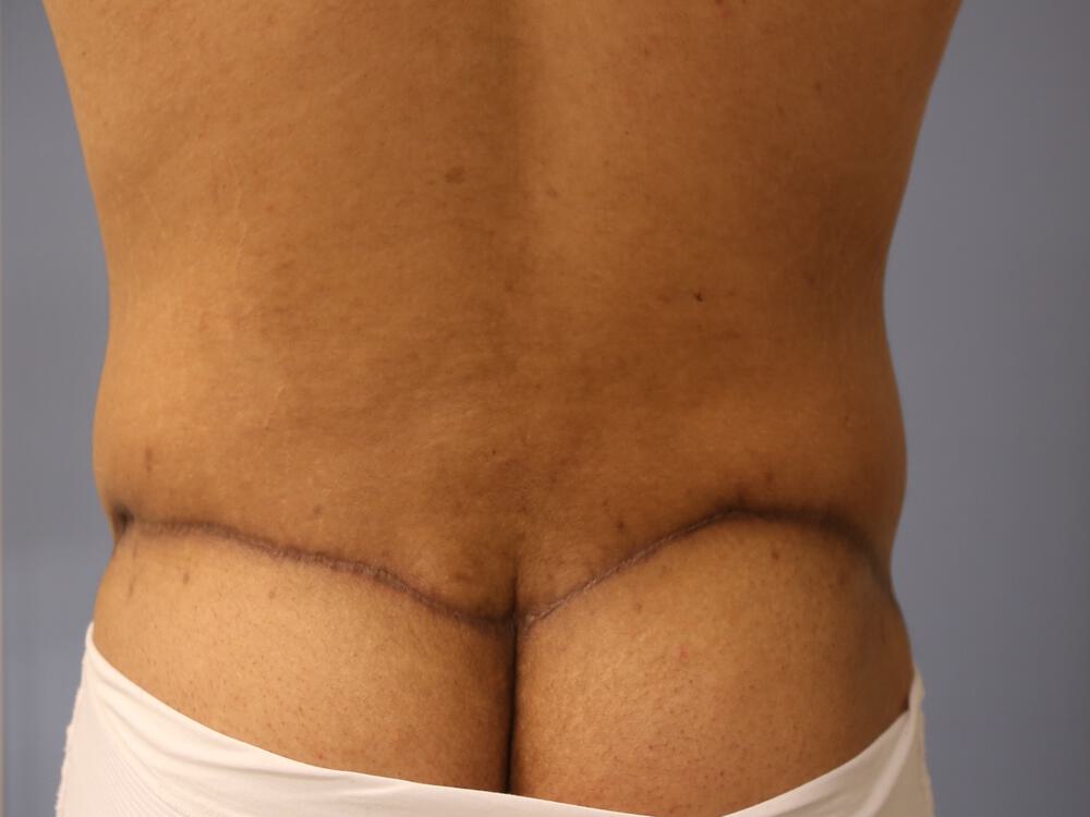 Surgery after weight loss Before & After Image