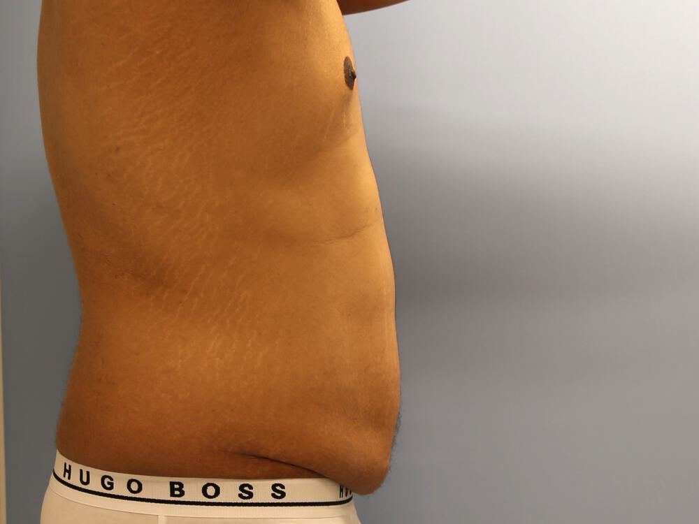 Surgery After Weight Loss Before & After Image