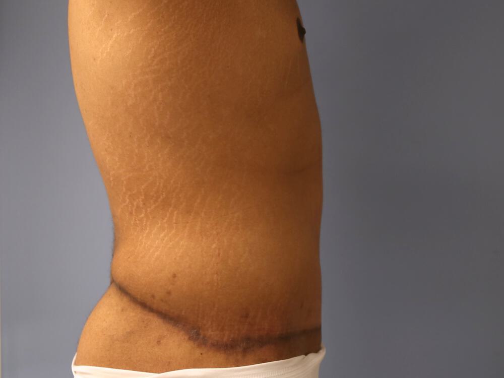 Surgery After Weight Loss Before & After Image