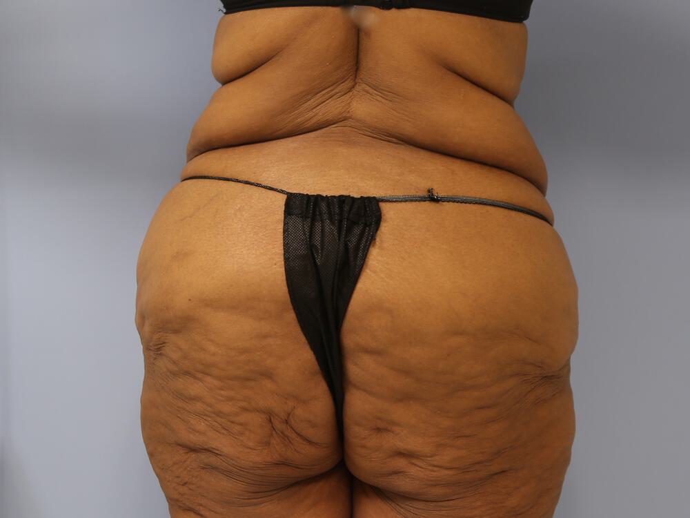 Surgery after weight loss Before & After Image