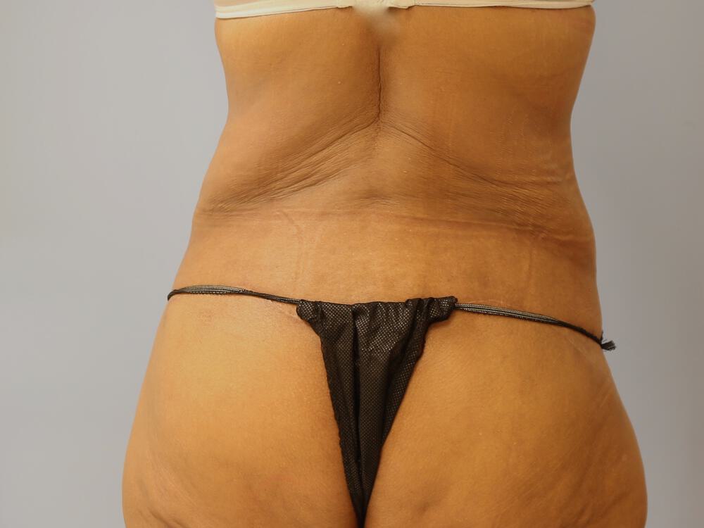 Surgery after weight loss Before & After Image