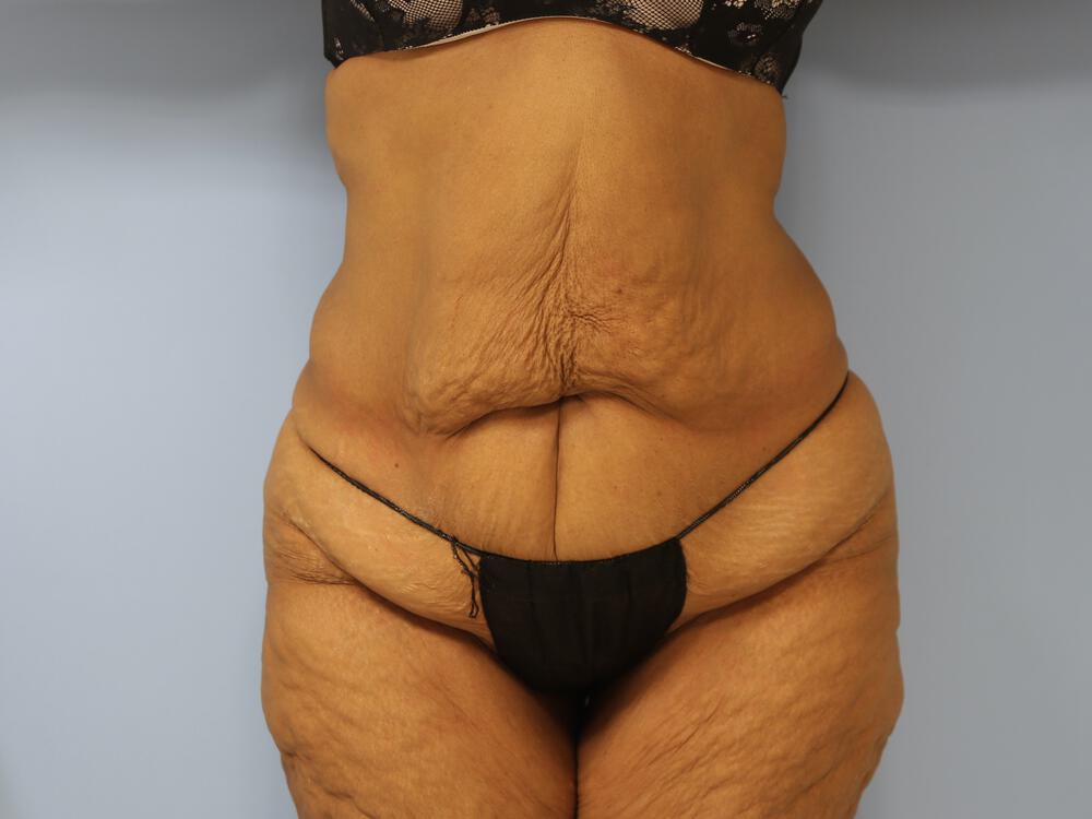 Surgery after weight loss Before & After Image