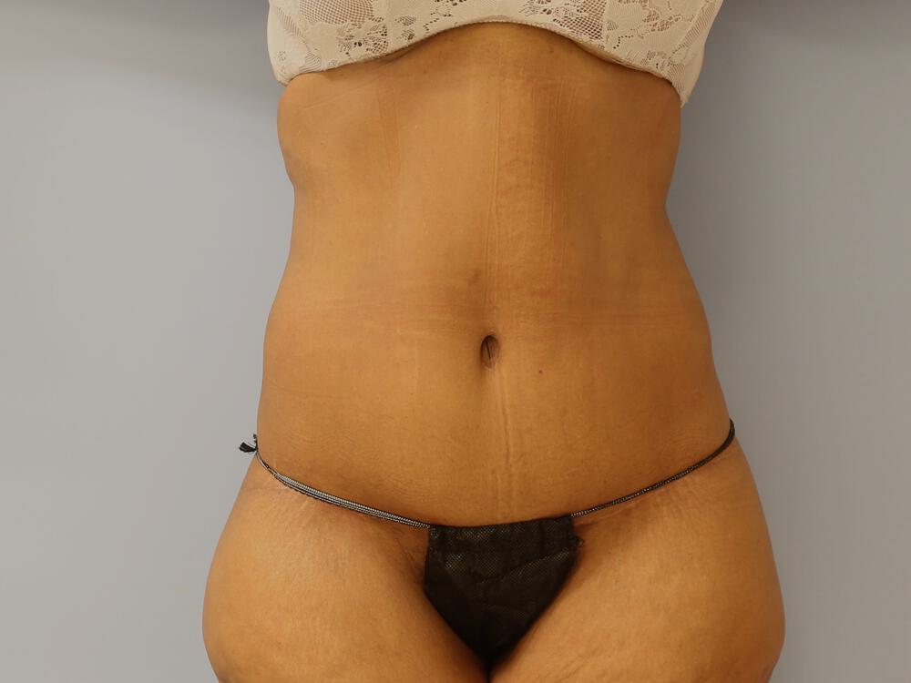 Surgery after weight loss Before & After Image