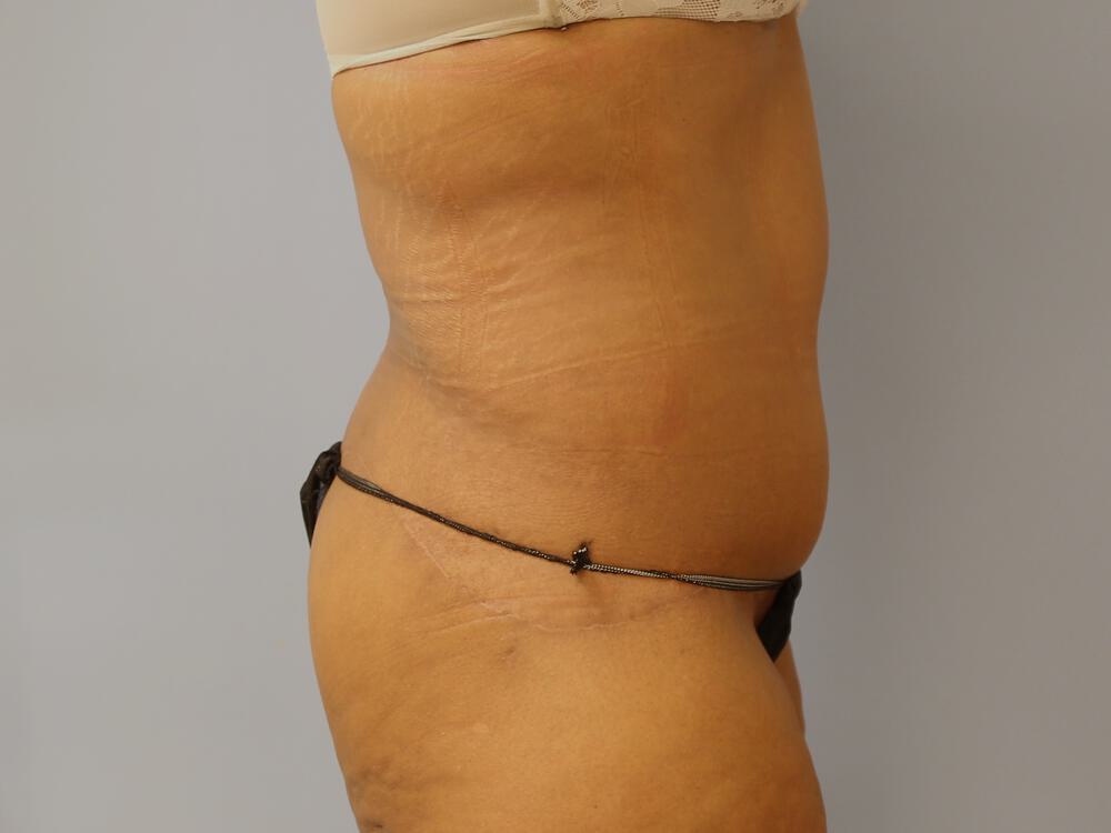 Surgery After Weight Loss Before & After Image