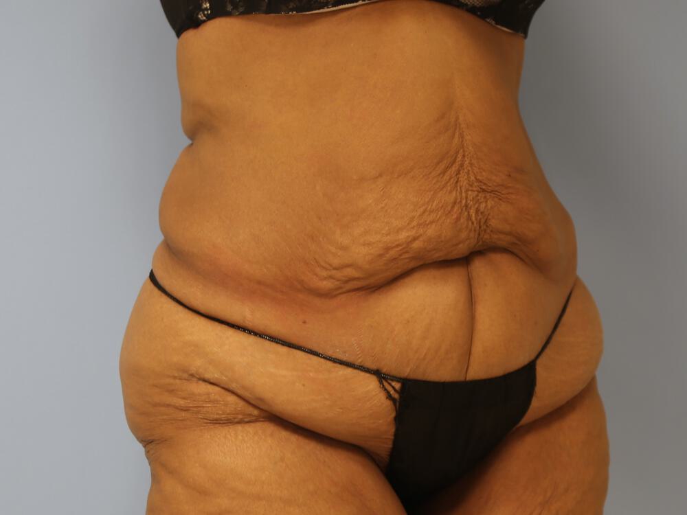 Surgery After Weight Loss Before & After Image