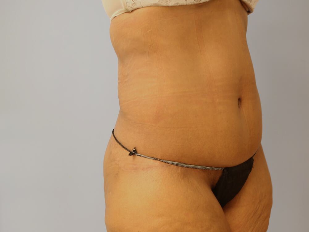 Surgery After Weight Loss Before & After Image