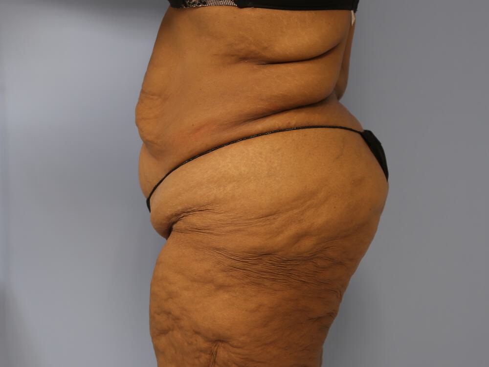 Surgery After Weight Loss Before & After Image