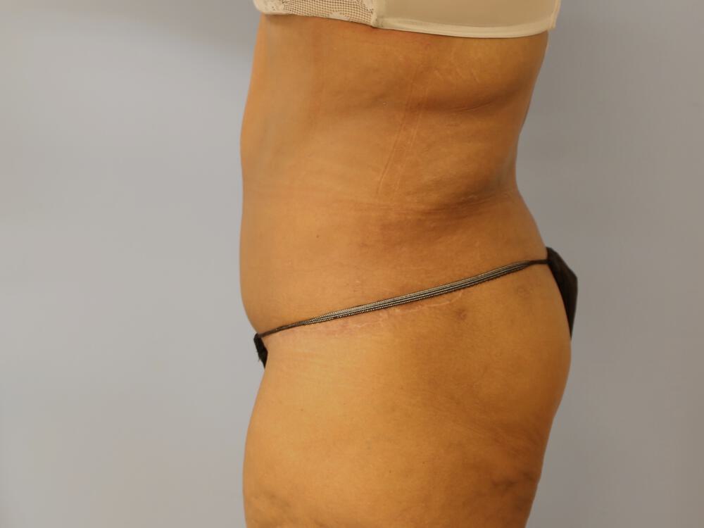 Surgery After Weight Loss Before & After Image