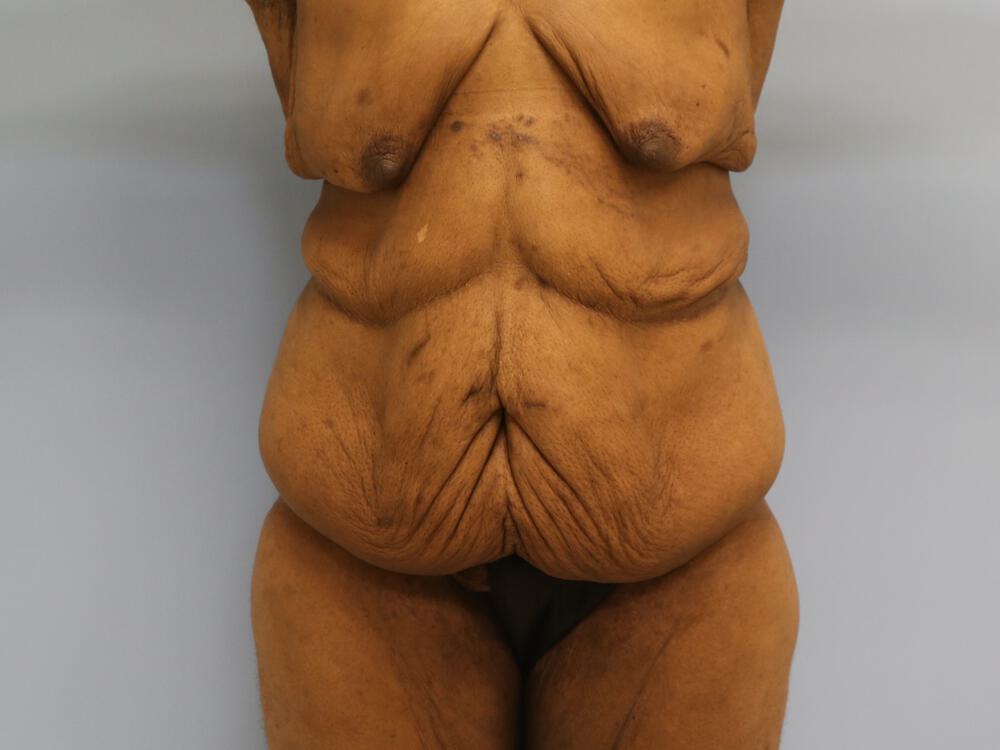 Surgery after weight loss Before & After Image