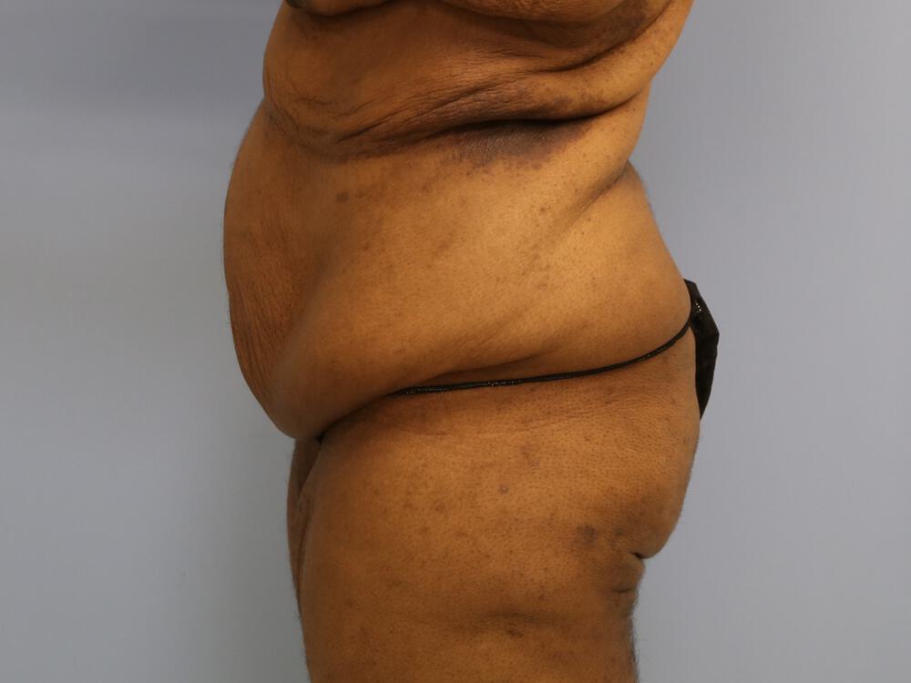 Surgery after weight loss Before & After Image