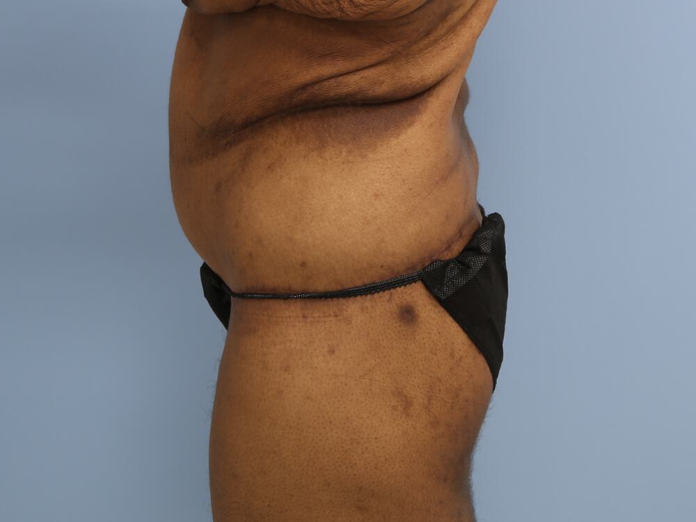 Surgery after weight loss Before & After Image