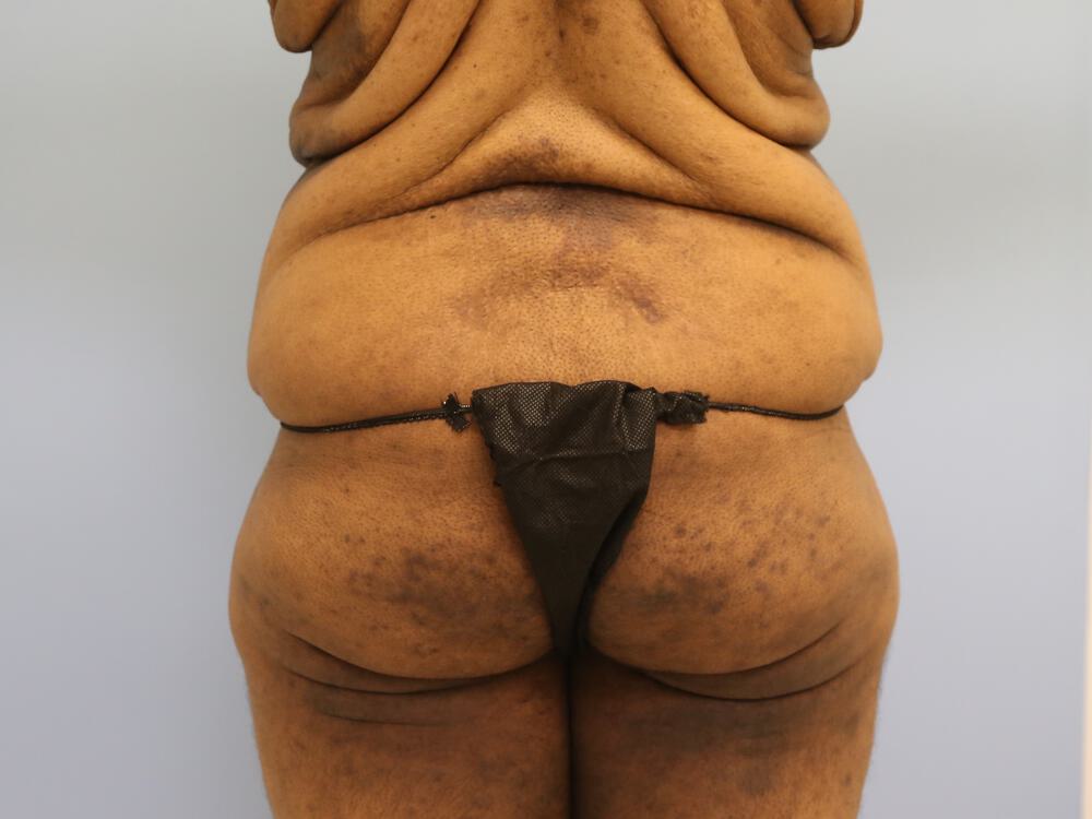 Surgery After Weight Loss Before & After Image