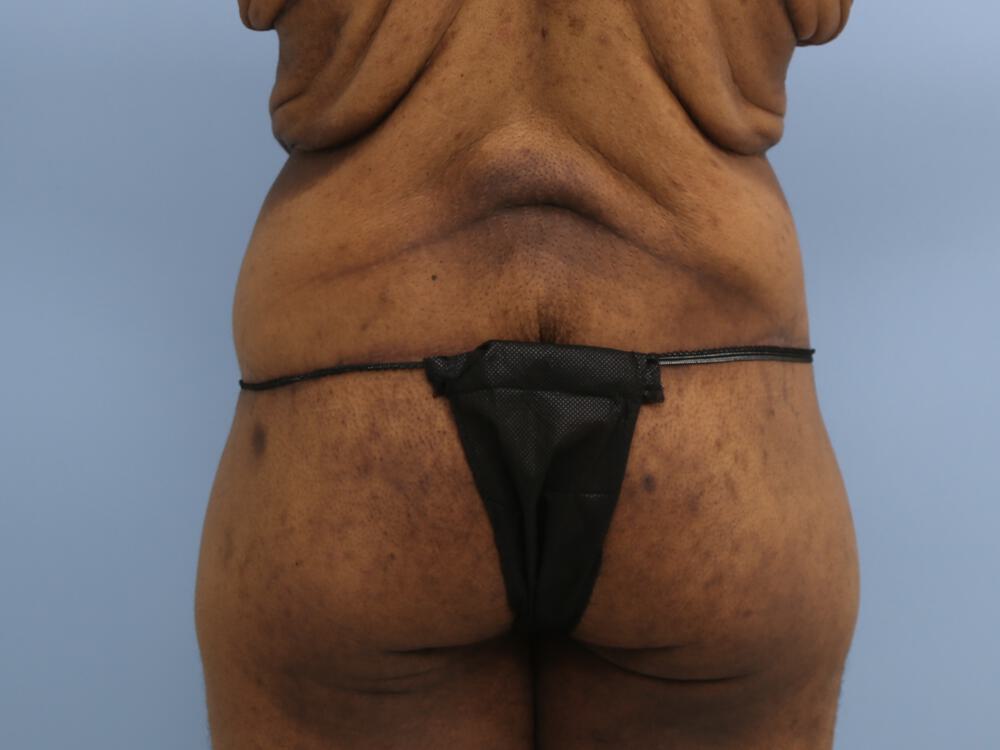 Surgery After Weight Loss Before & After Image