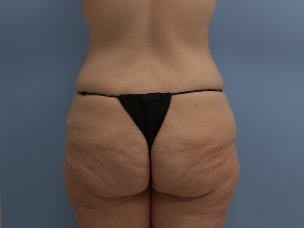 Surgery after weight loss Before & After Image