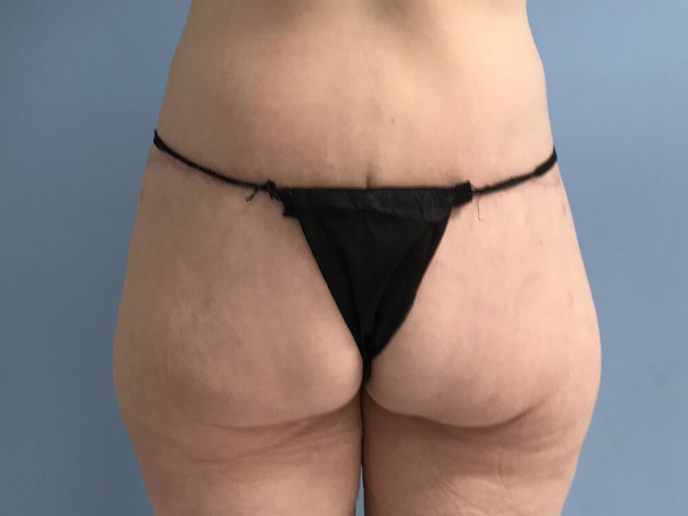 Surgery after weight loss Before & After Image