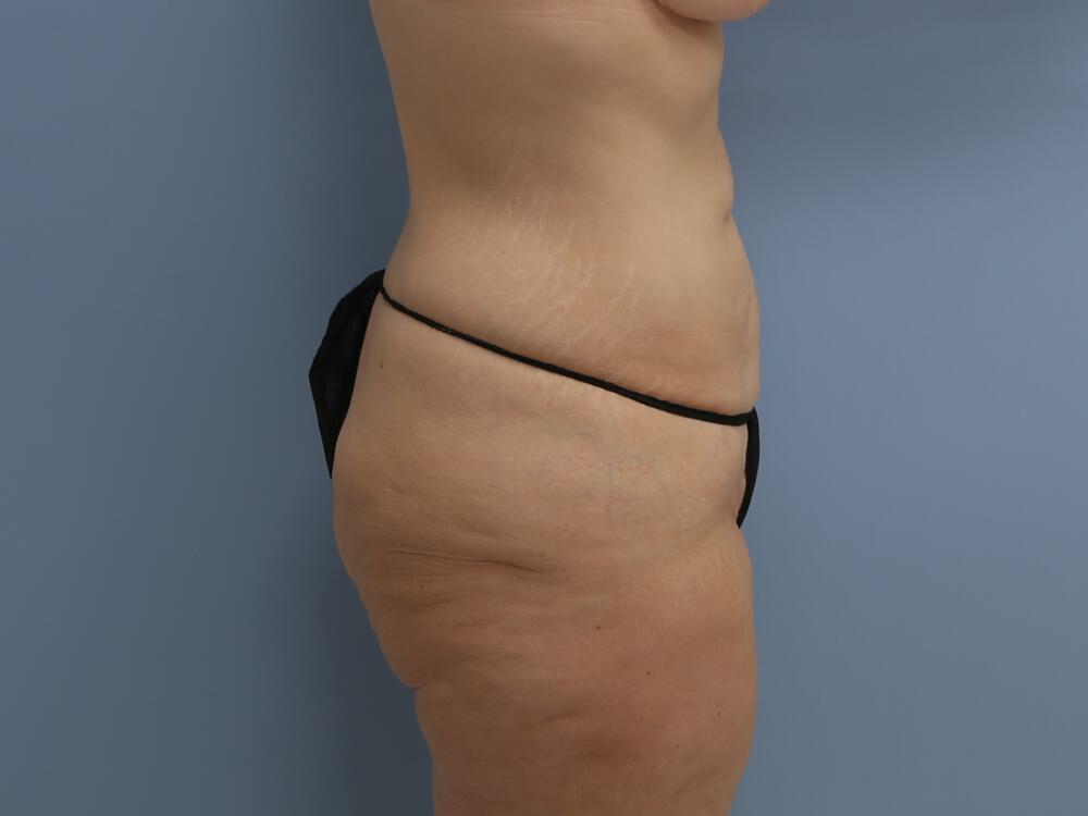 Surgery After Weight Loss Before & After Image