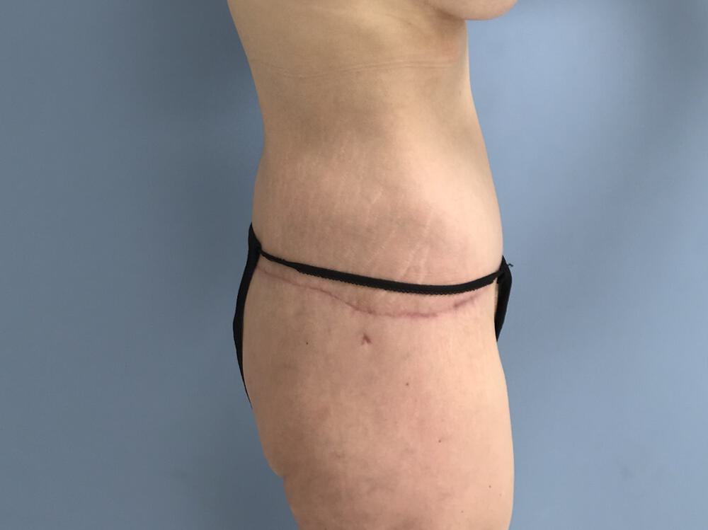 Surgery After Weight Loss Before & After Image