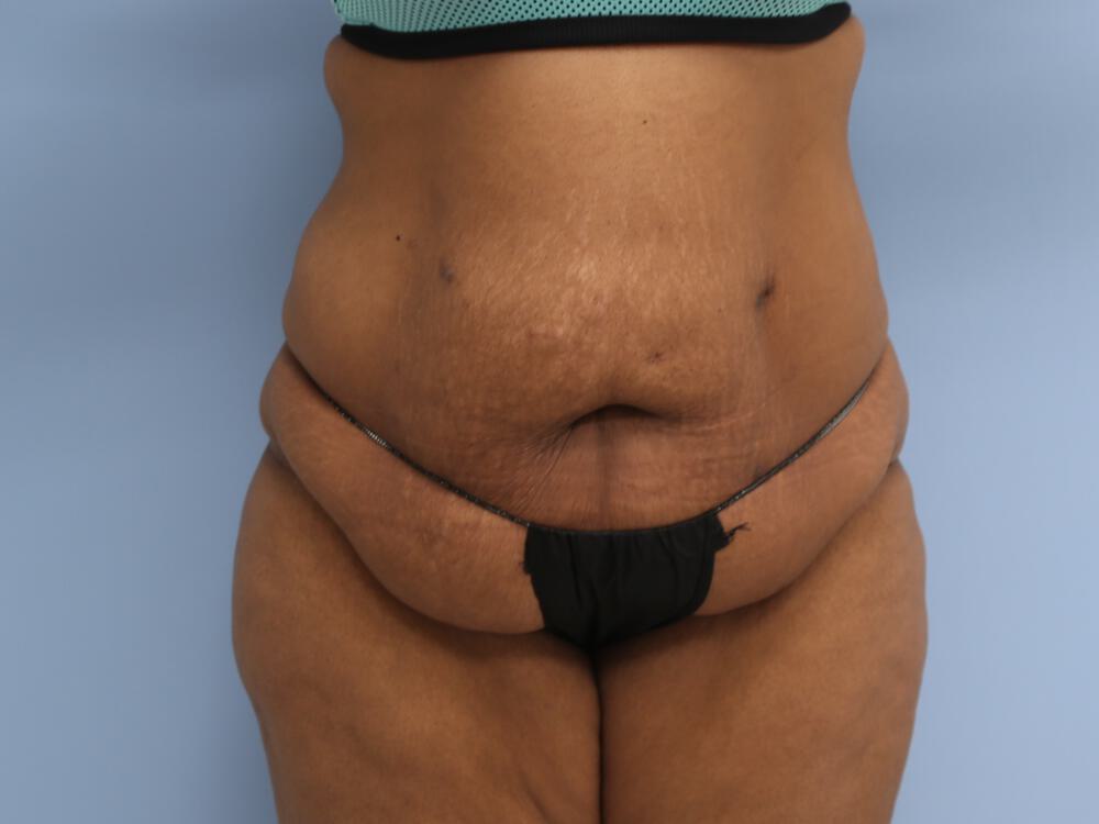 Surgery after weight loss Before & After Image