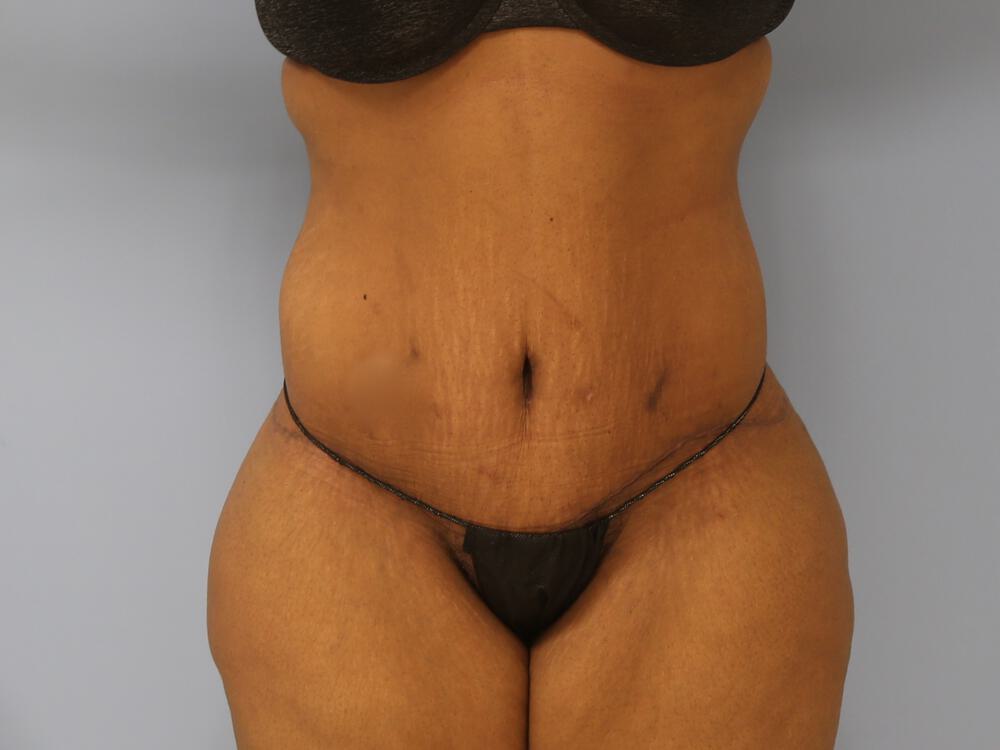 Surgery after weight loss Before & After Image
