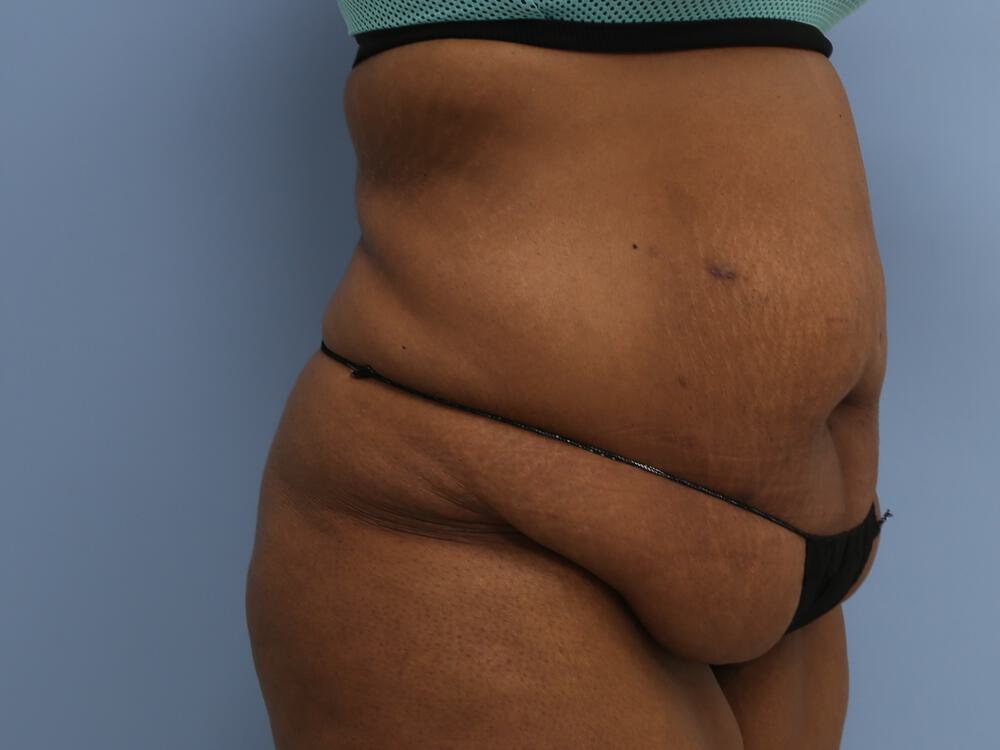 Surgery after weight loss Before & After Image