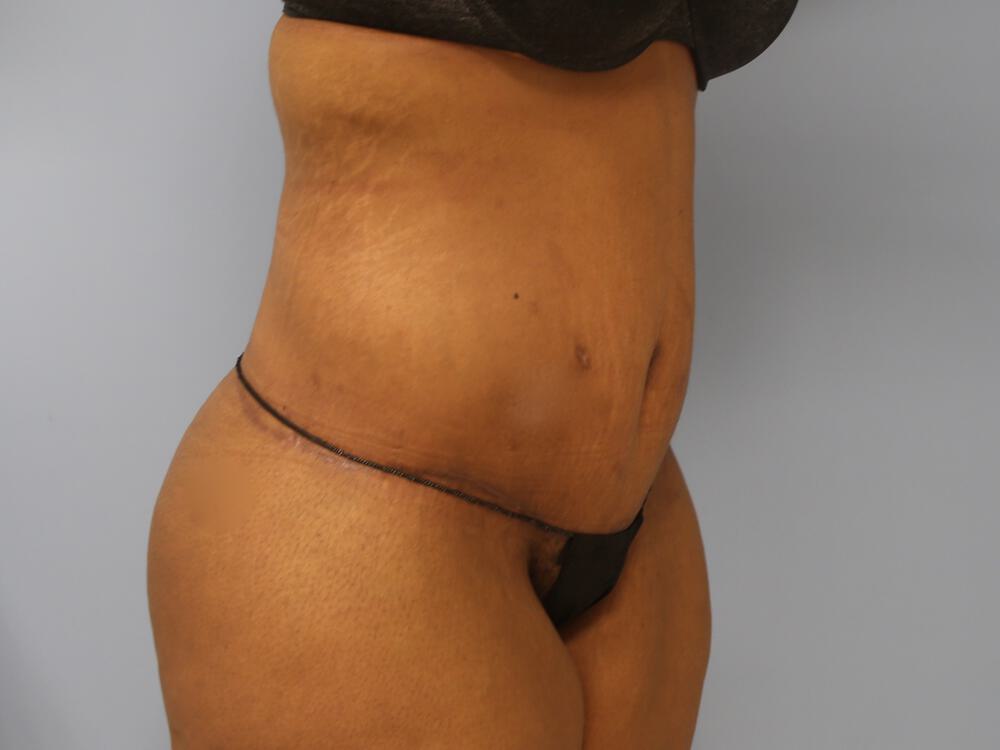 Surgery after weight loss Before & After Image