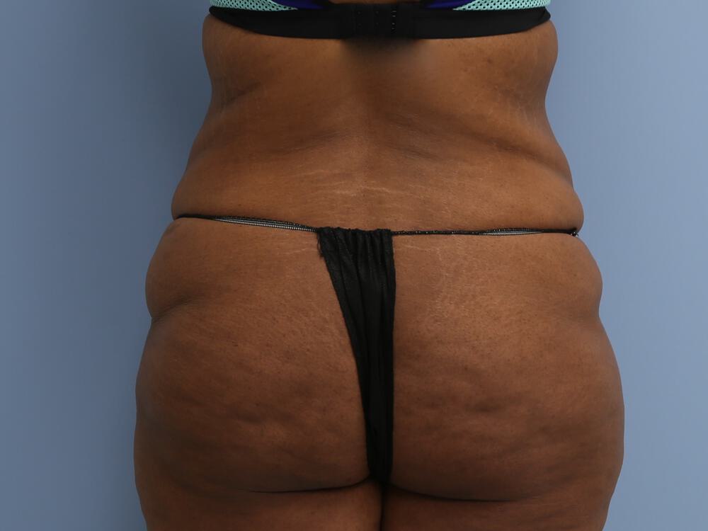 Surgery After Weight Loss Before & After Image