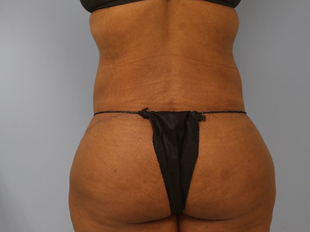 Surgery After Weight Loss Before & After Image