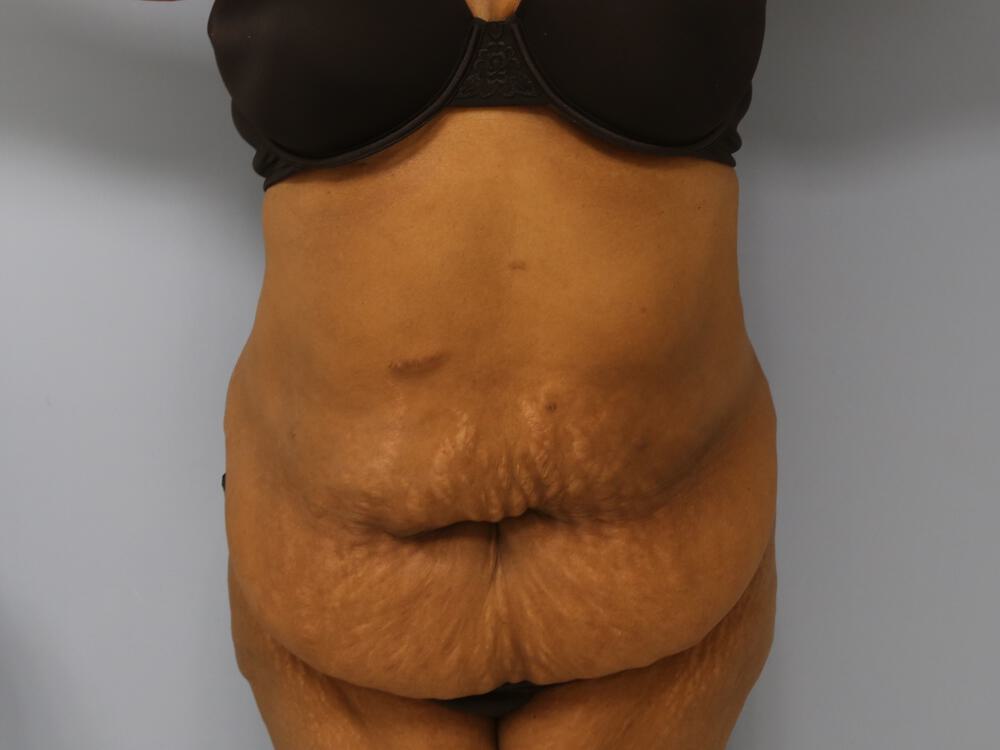 Surgery after weight loss Before & After Image