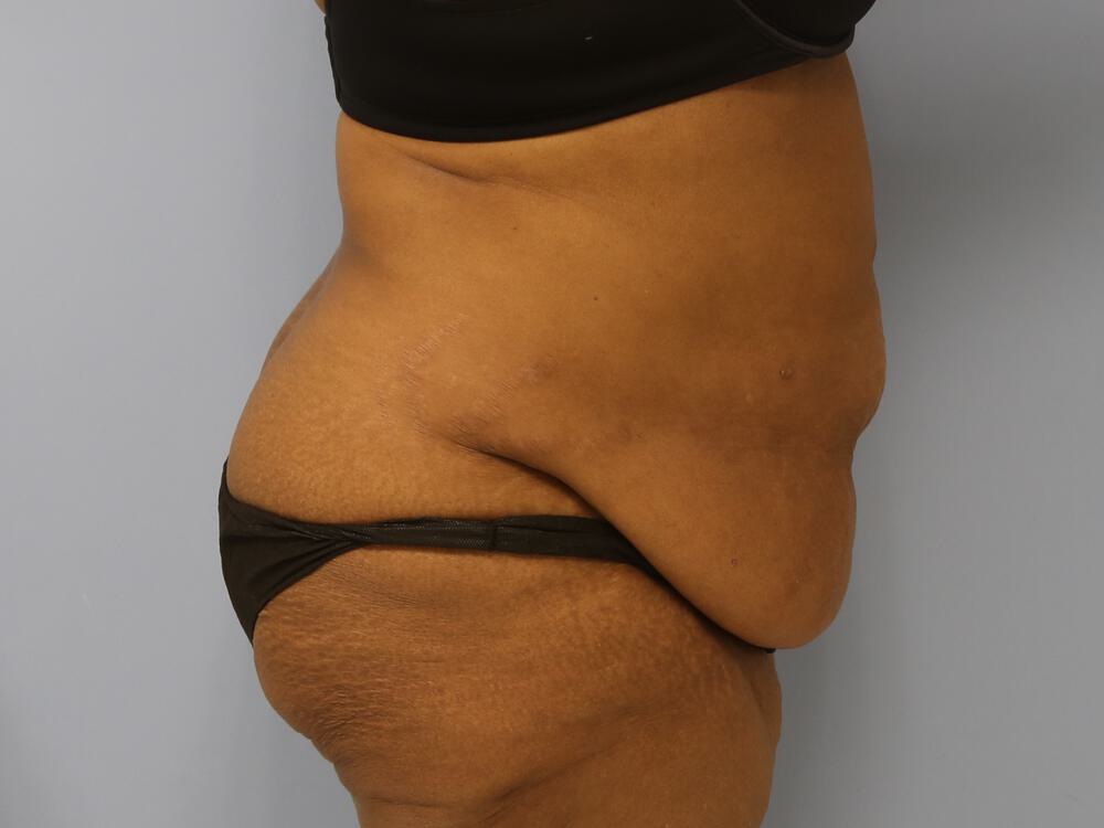 Surgery after weight loss Before & After Image