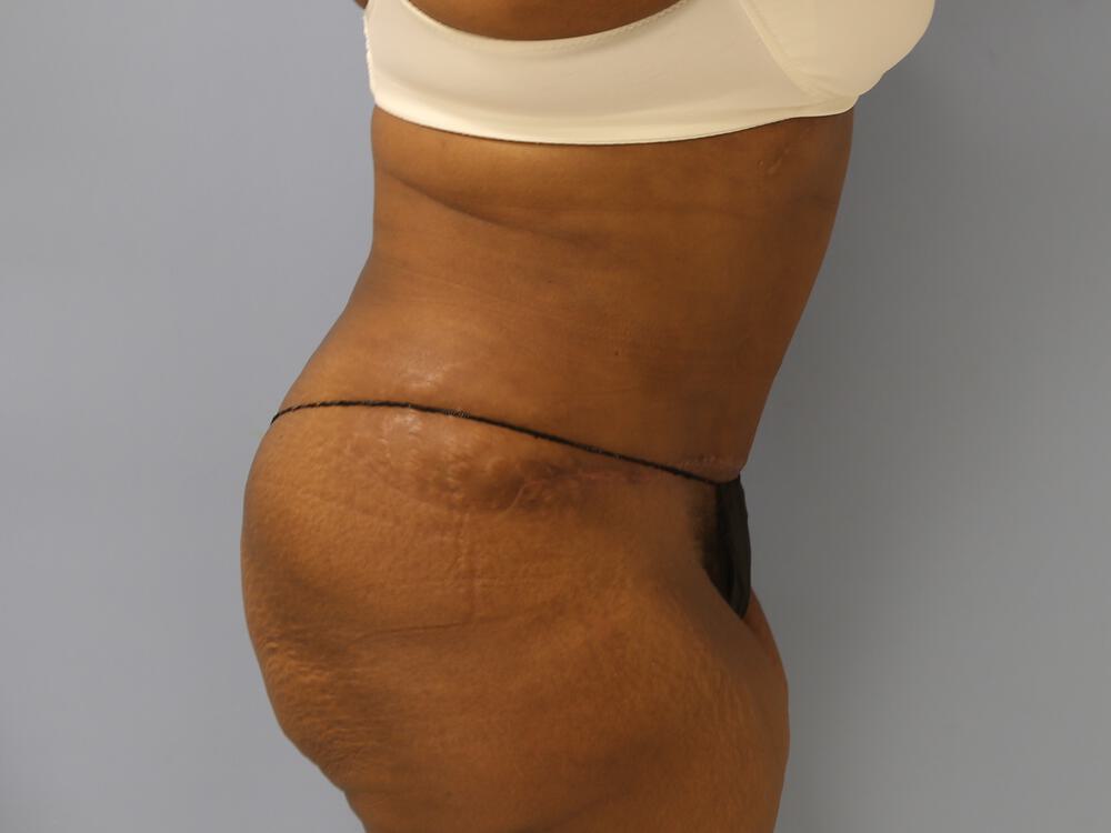 Surgery after weight loss Before & After Image